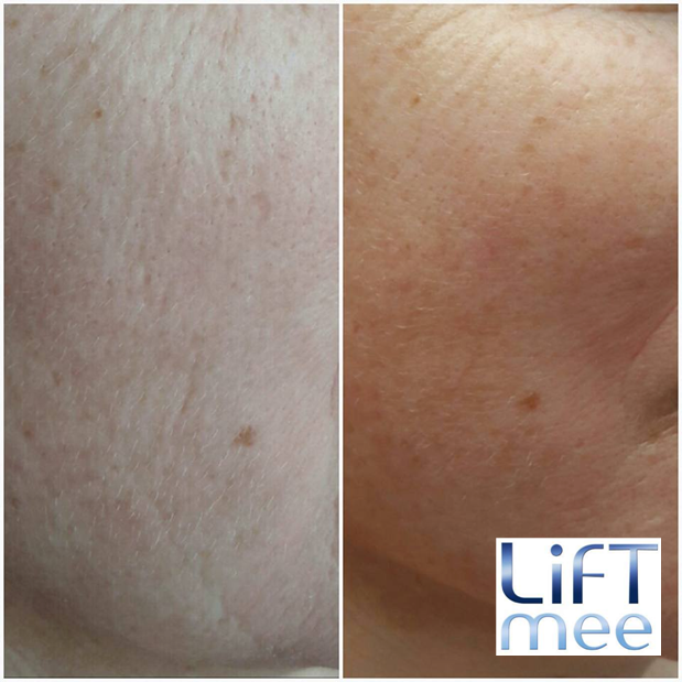 Led mask anti-aging treatment