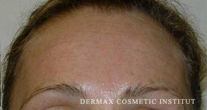 Vitalaser wrinkle filling forehead after