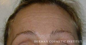 Vitalaser wrinkle filling forehead before
